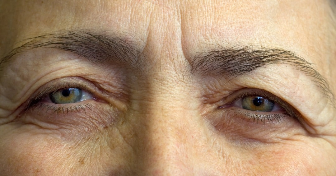 Upper Blepharoplasty Recovery Photos Day by Day