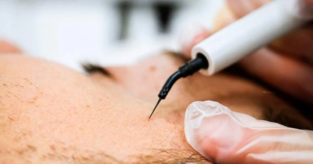 Mastering Skin Perfection: Guide to Hyfrecator Treatments