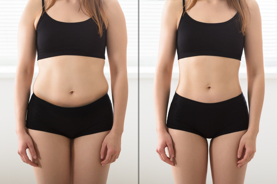 Top Liposuction Options for Effective Body Contouring