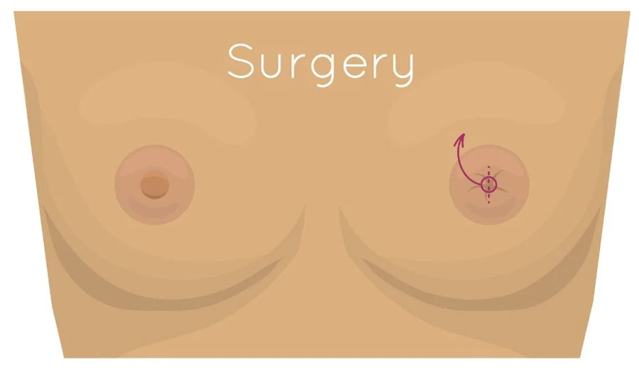 Inverted Nipple Surgery: A Comprehensive Guide to Safe Correction