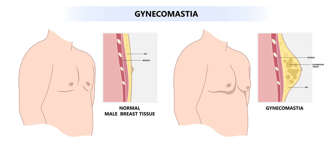Gynecomastia Pinch Test
