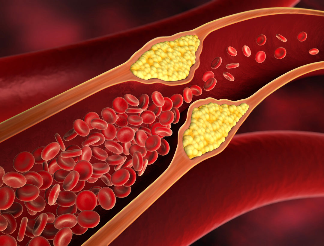 Cholesterol & ApoB: Beyond the Standard Lipid Panel