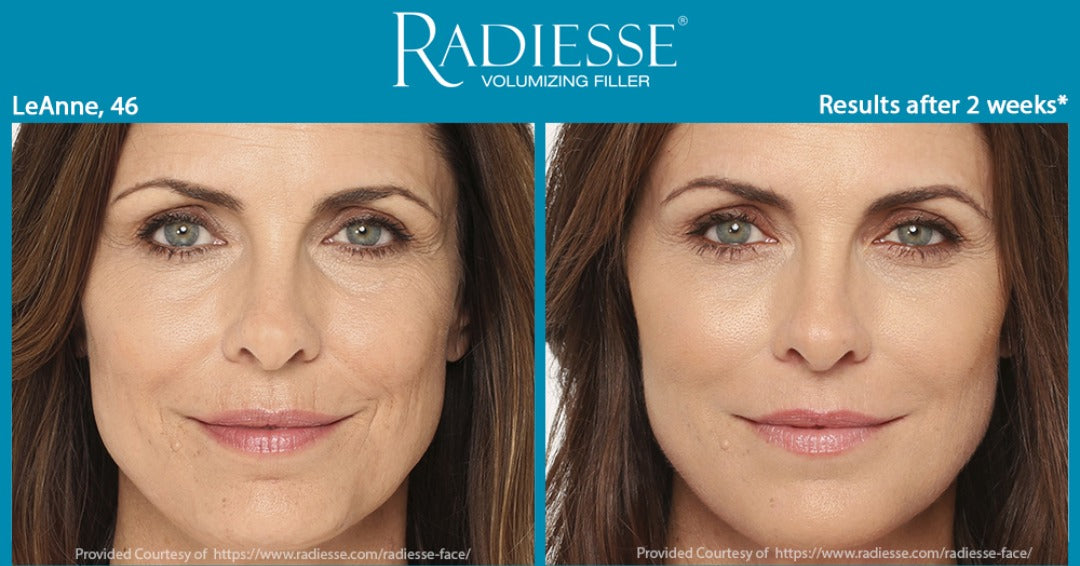 Radiesse Filler: Benefits, Procedure, and Results Explained – Leva Medical