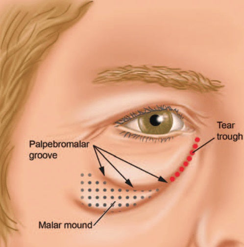 Understanding and Tear Trough Fillers and Treating Eyelid Edema