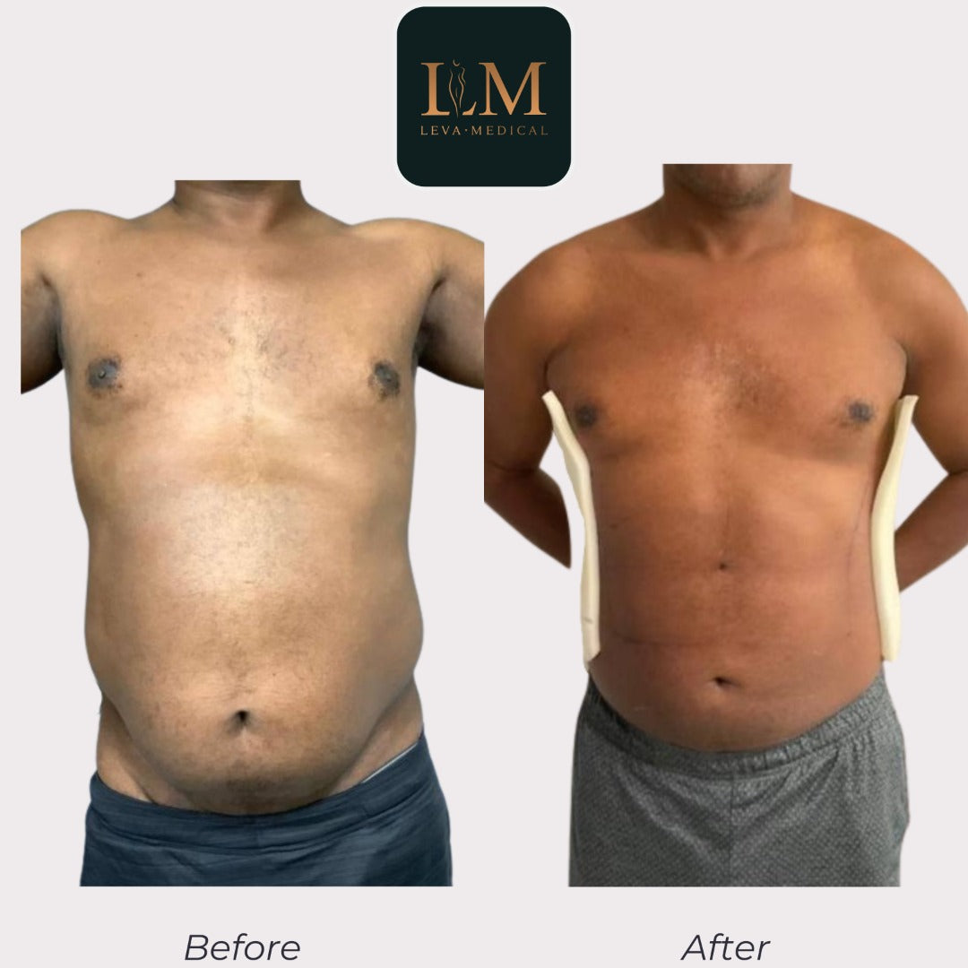 Hi Def Liposuction Sculpt And Contour Your Body Leva Medical   Simple Hair Salon Before And After 6 