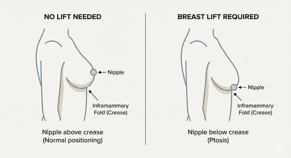Breast lift required