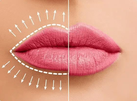 Dermal Fillers (Injectables)