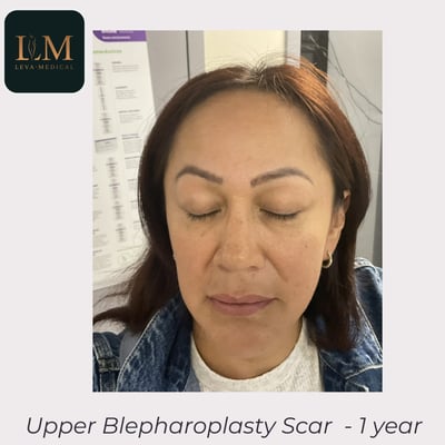 Male patient upper blepharoplasty before and after