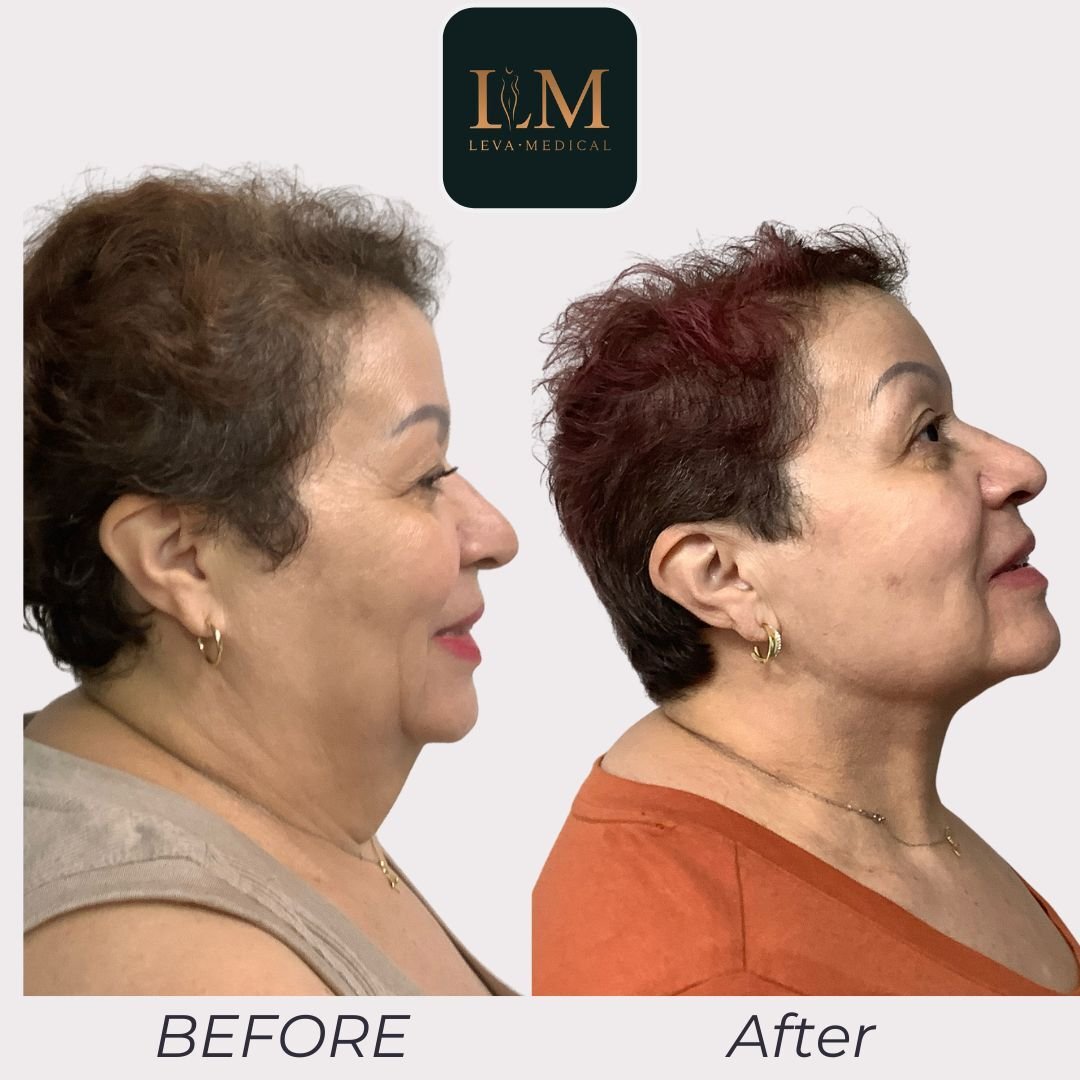Lipoplasty Neck