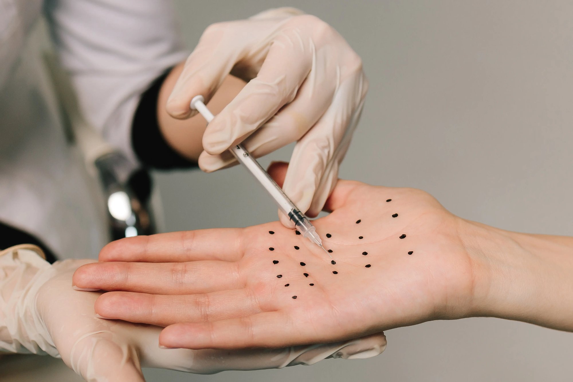 Illustrative clinical stock photo of a gloved clinician injecting a palm marked with a grid of treatment points; not a Leva patient