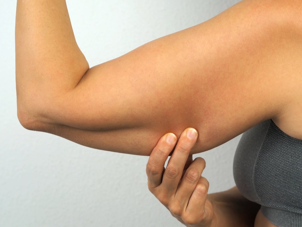 Parte superior del brazo de una paciente para la planificación de una braquioplastia