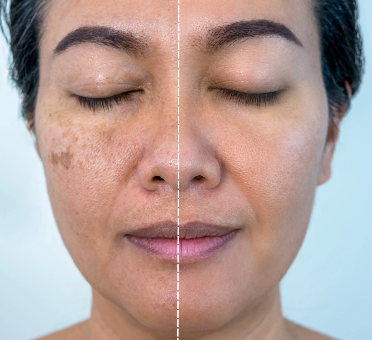 Comparación ilustrativa de archivo de melasma facial antes y después, en un mismo rostro dividido por la mitad; no muestra pacientes de Leva