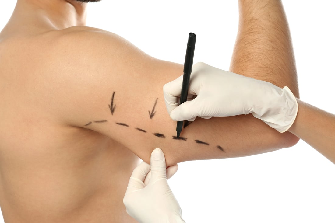Marcaciones preoperatorias del brazo para una braquioplastia