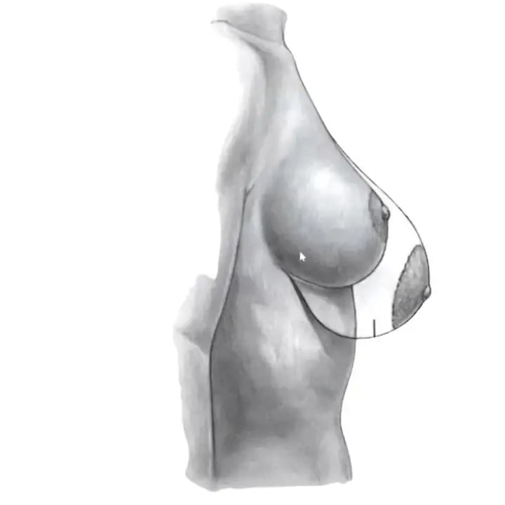 Illustrative grayscale medical drawing of a breast in profile with mastopexy lift markings; not a Leva patient