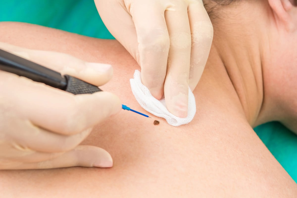 Illustrative stock photo of a clinician marking a mole before removal; not a Leva patient