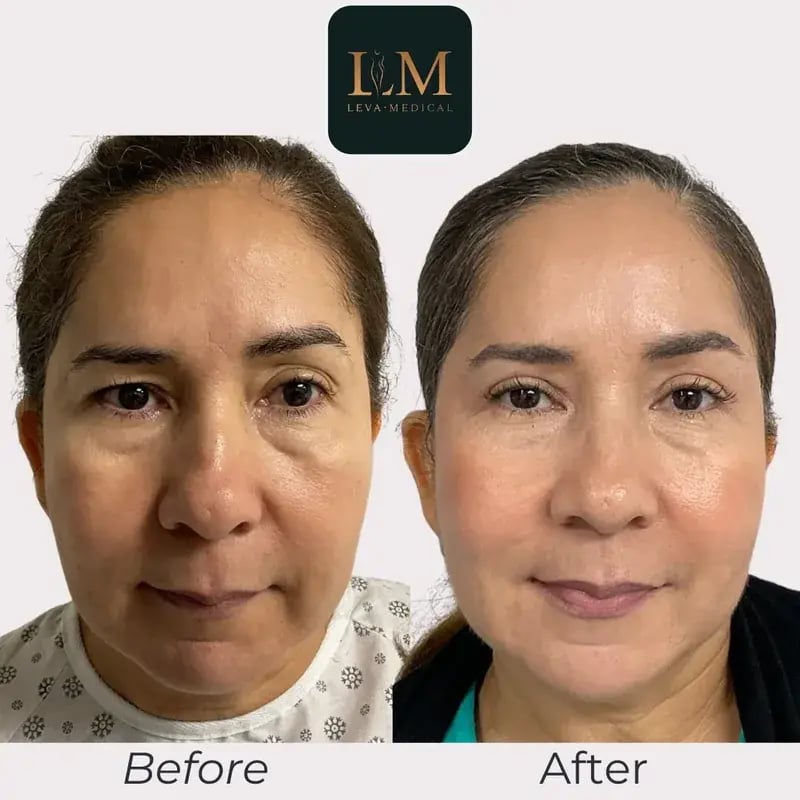 bleph-gallery-before-after-female