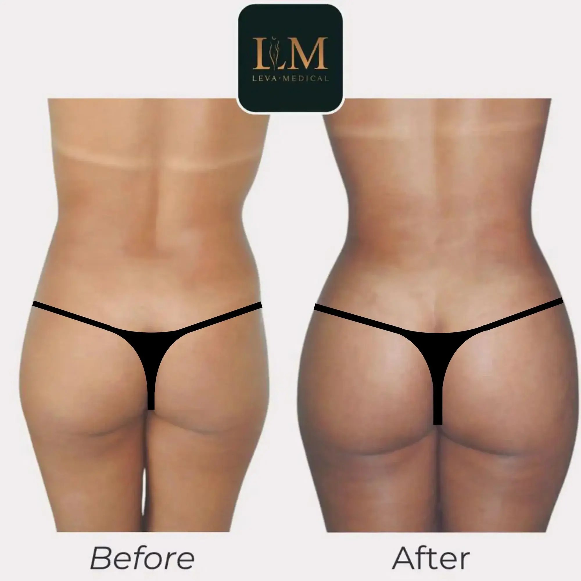 body lipo