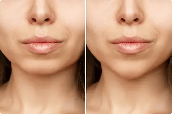 Illustrative stock before-and-after comparison of a chin and lower face; not a Leva patient