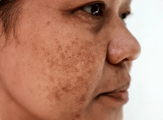 Pigment & Melasma Care