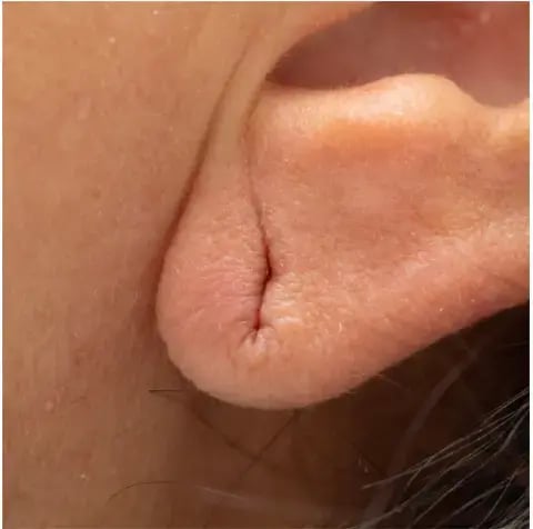 lobe repair