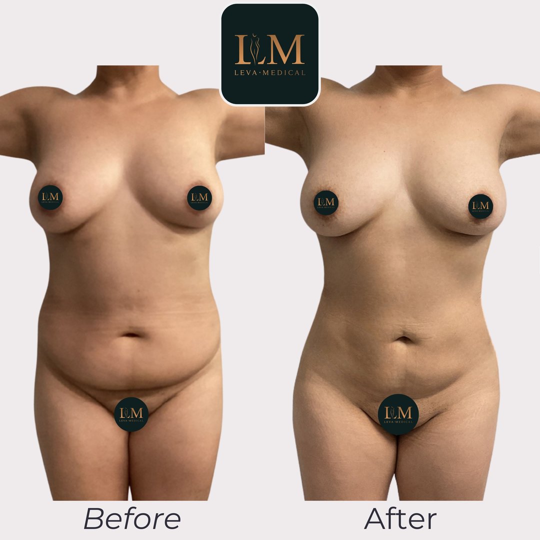 Lipoplasty + Abdominoplasty