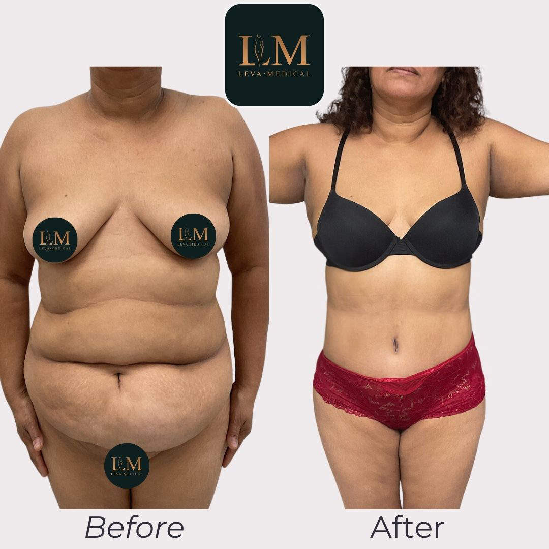 Abdominoplasty