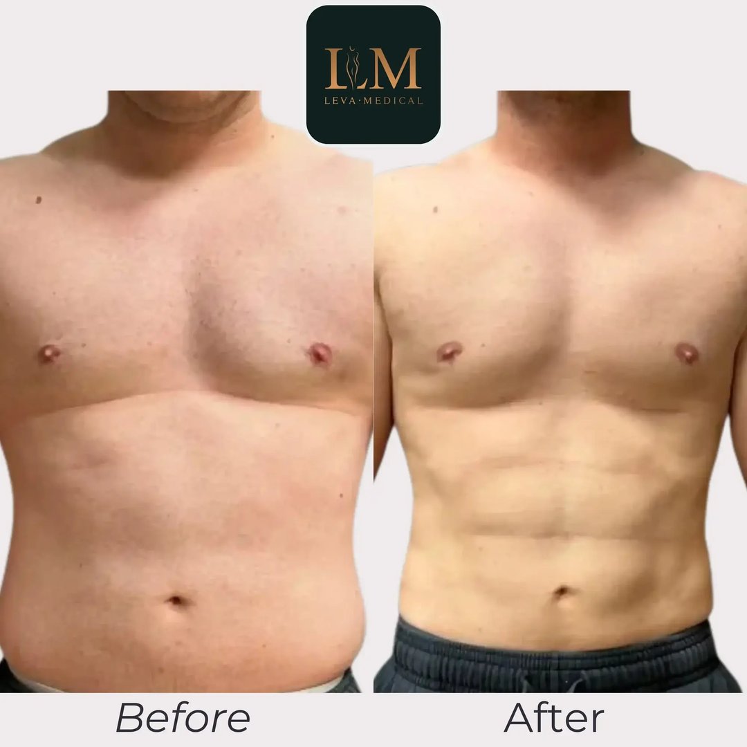 Male Abdominoplasty