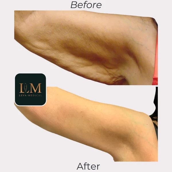 Arm Lipoplasty