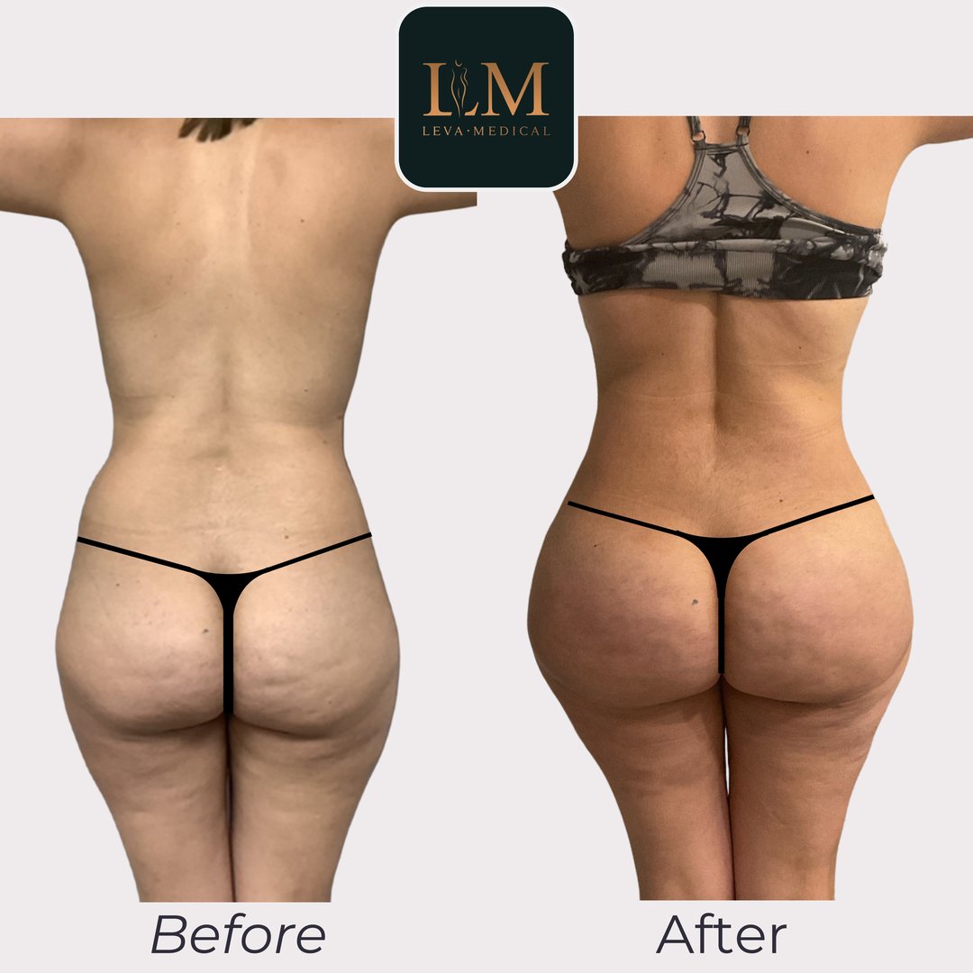 Brazilian Butt Lift
