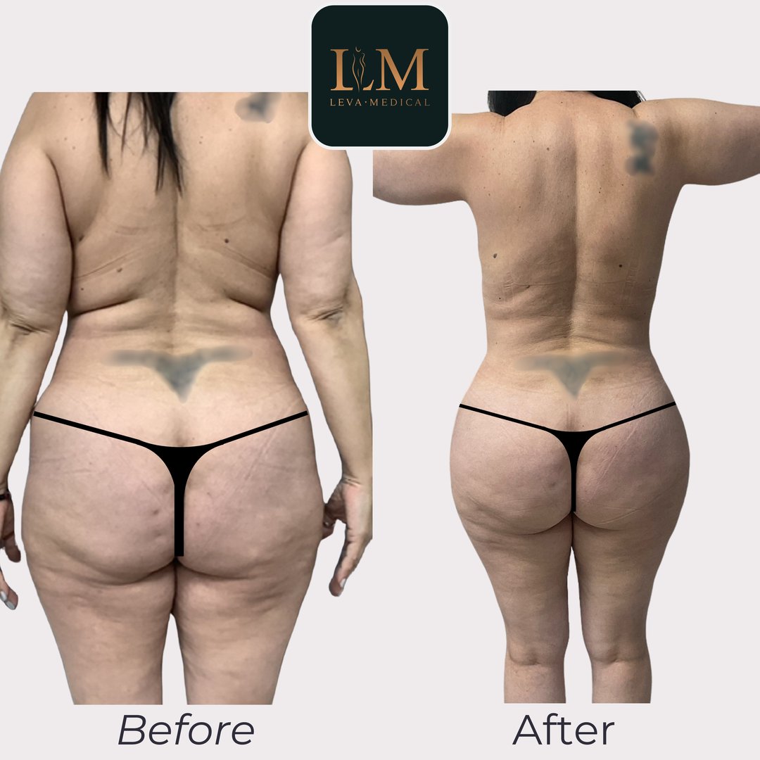Back Contouring + BBL