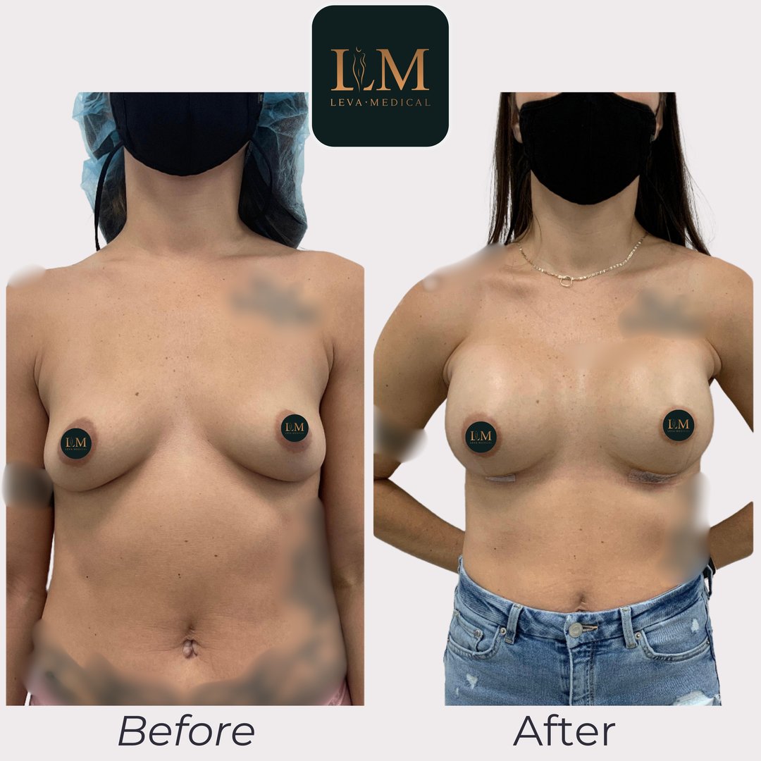 Breast Augmentation