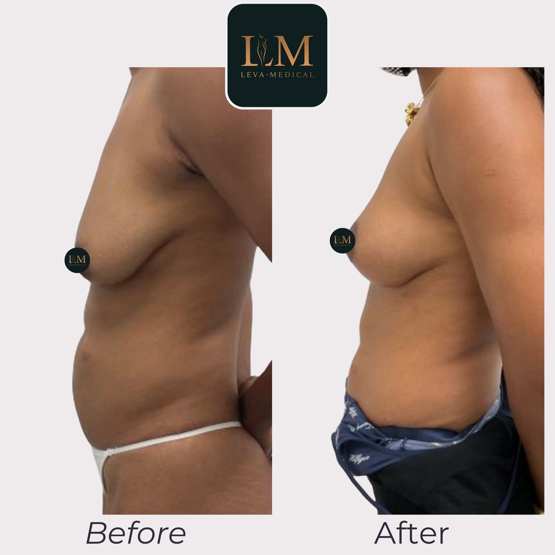 Breast Lift (Mastopexy)
