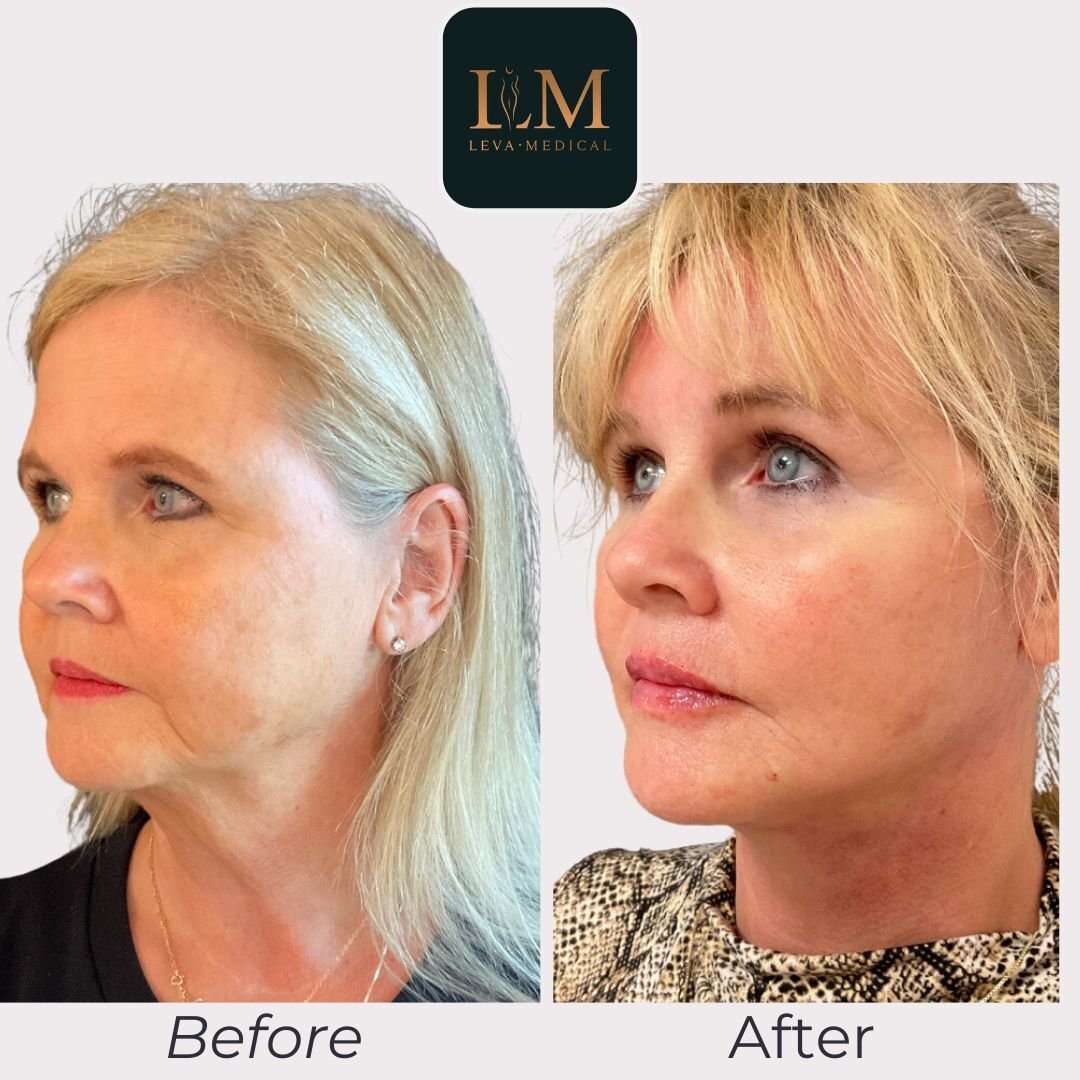 Facelift + Necklift