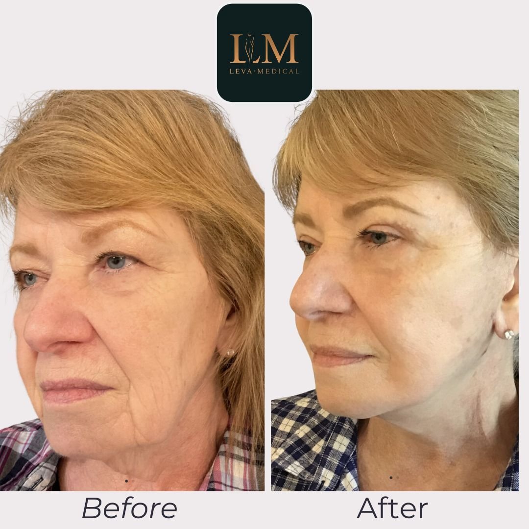 Facelift