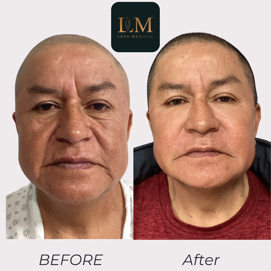 Facial Fat Grafting