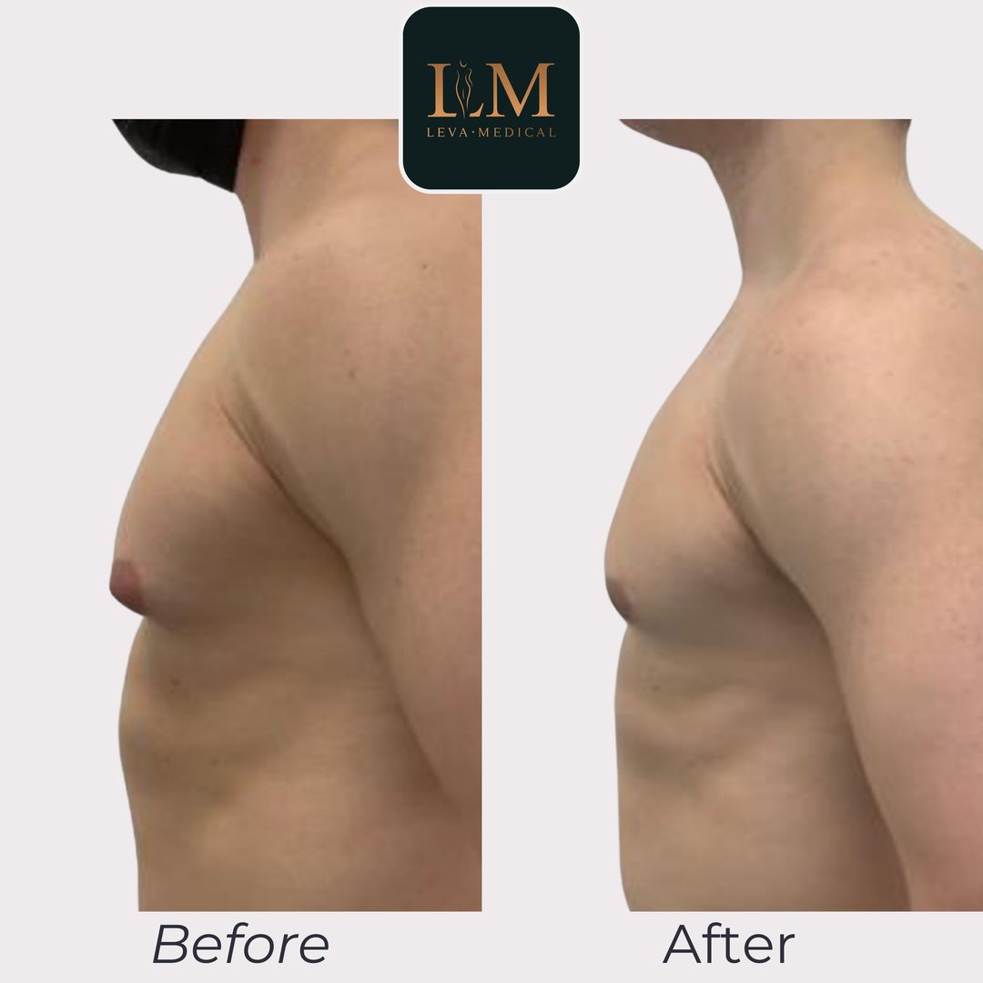 Gynecomastia Correction