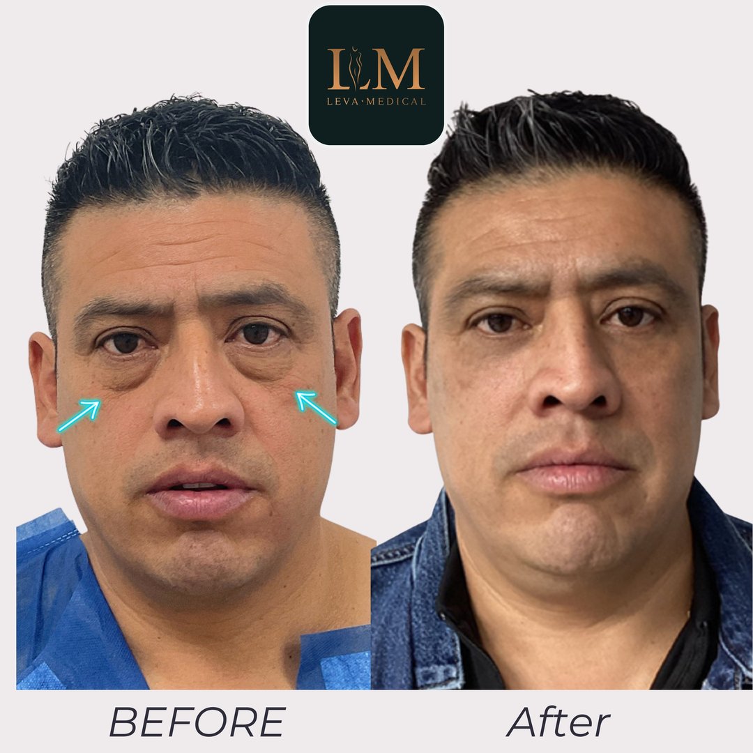 Lower Blepharoplasty