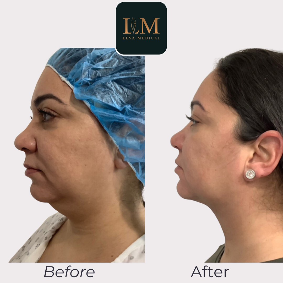 Neck Lipoplasty
