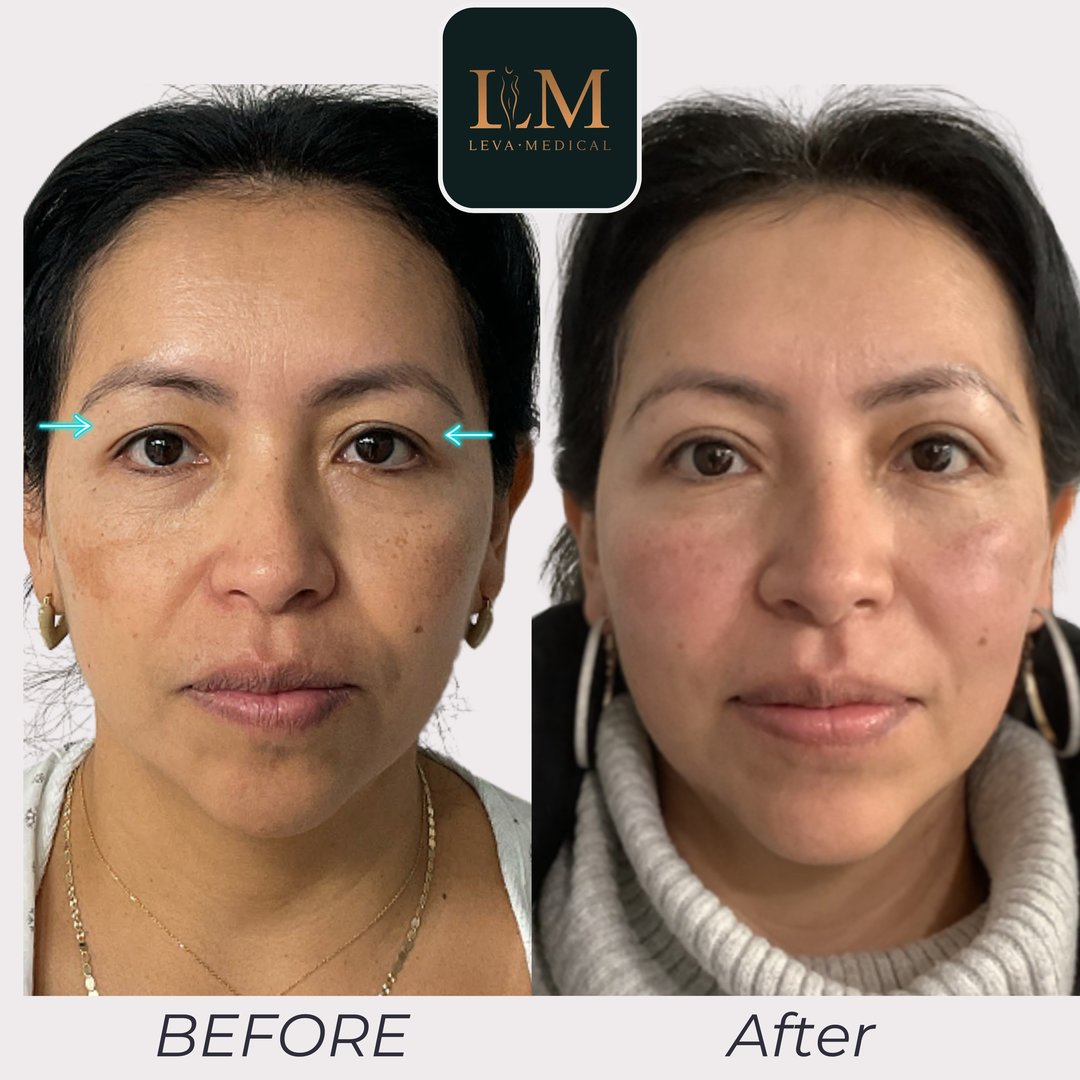 Upper Blepharoplasty