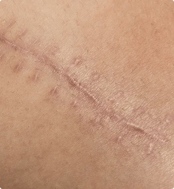 scar