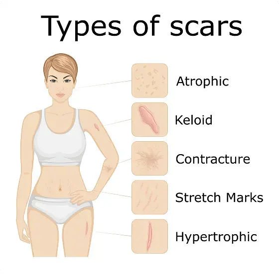 scars