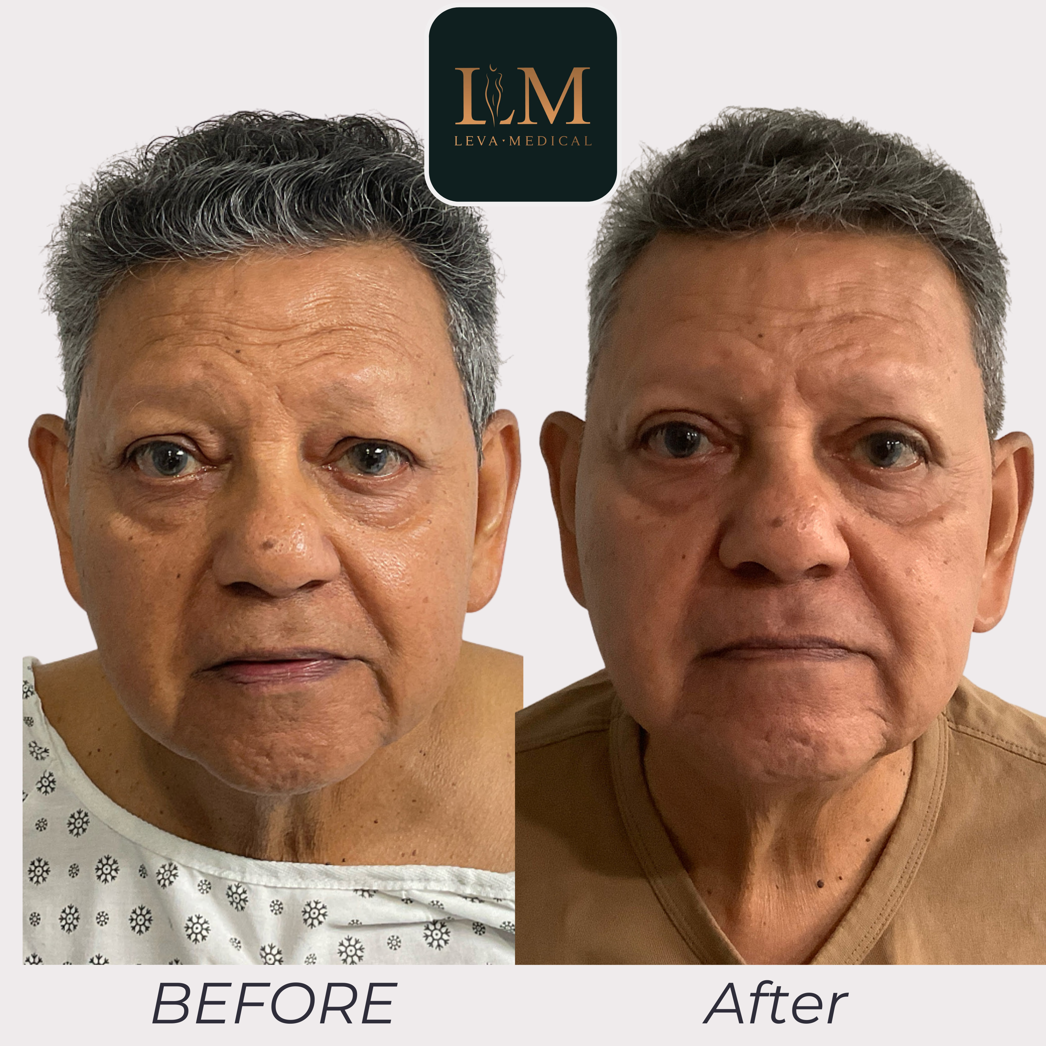 Upper Bleph - 3 months