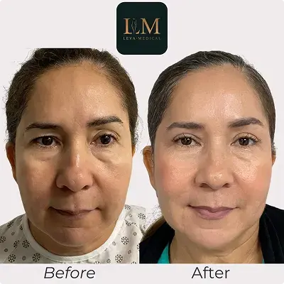 before-and-after-1