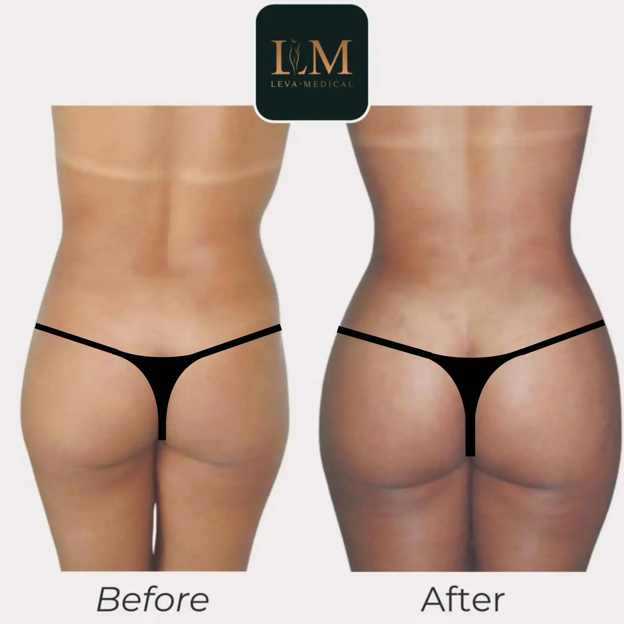 body lipo